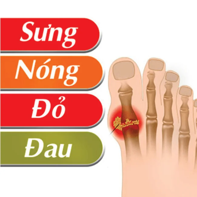 Benh Gout Co Nguy Hiem Khong 