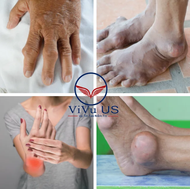 Viên Uống Gout Clear 60 Viên Usa (Cao Cấp) 6 Gout Nguy Hiểm Như Thế Nào